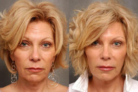 1. image before and after the application of the Goji Cream