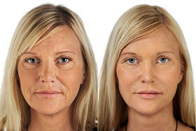 2. image before and after the application of the Goji Cream