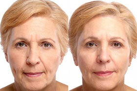3. image before and after the application of the Goji Cream