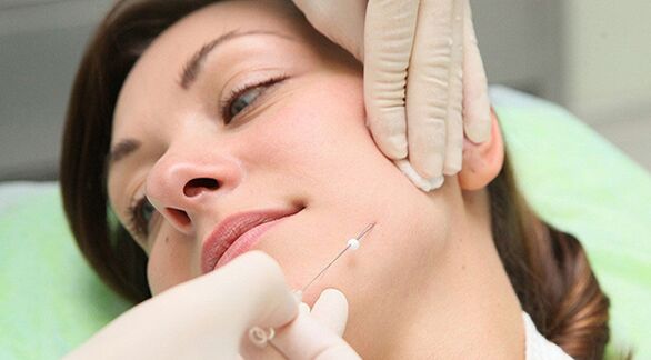 Thread lift - cosmetic method to rejuvenate the face after 45 years old