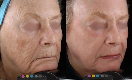 before and after photos of laser rejuvenation