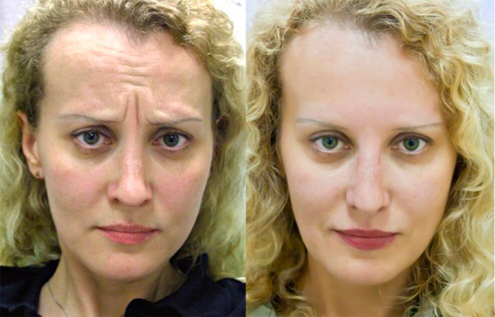 before and after using massager to rejuvenate ltza photo 1