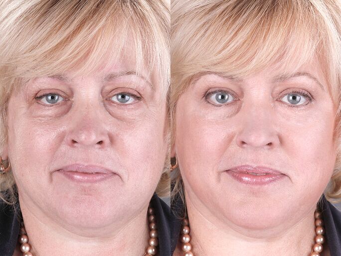 before and after using massager to rejuvenate ltza photo 3