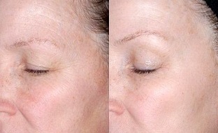 rejuvenate the eye area before and after taking a photo