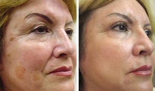 Skin rejuvenation segments before and after photo