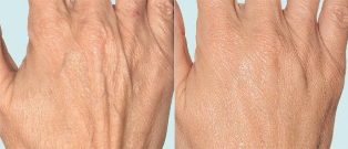 Hand skin before and after fractional treatment