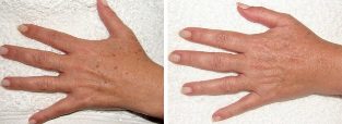 The results of the removal of age spots on the hands