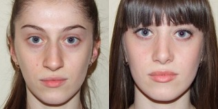 before and after skin rejuvenation by plasma