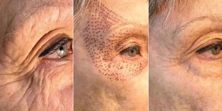 photo before and after skin rejuvenation with plasma