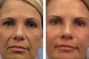 results of mesotherapy